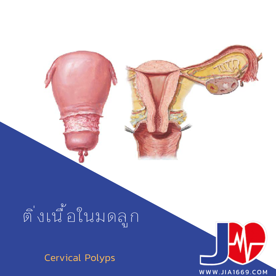 ติ่งเนื้อในมดลูก ติ่งเนื้อในมดลูก