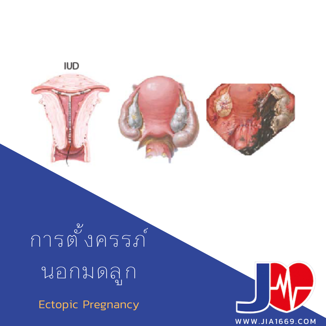 การตั้งครรภ์นอกมดลูก  การตั้งครรภ์นอกมดลูก