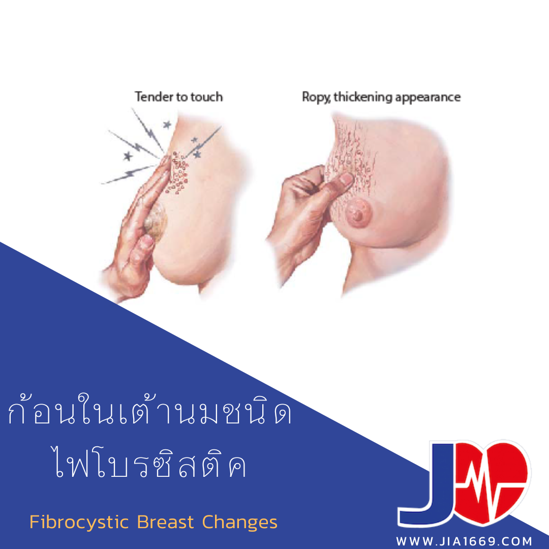 ก้อนในเต้านมชนิดไฟโบรซิสติค  ก้อนในเต้านมชนิดไฟโบรซิสติค