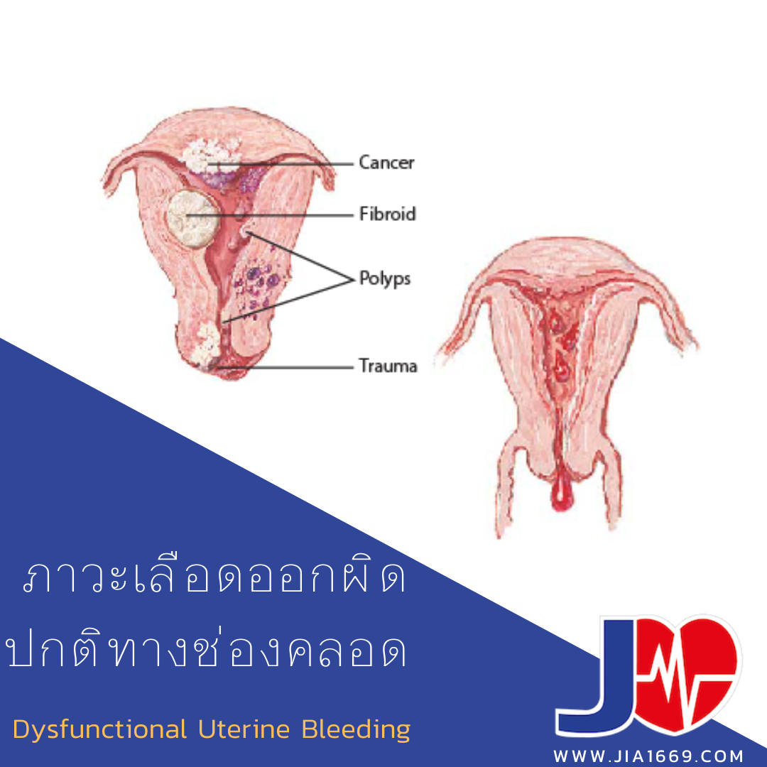 ภาวะเลือดออกผิดปกติทางช่องคลอด ภาวะเลือดออกผิดปกติทางช่องคลอด
