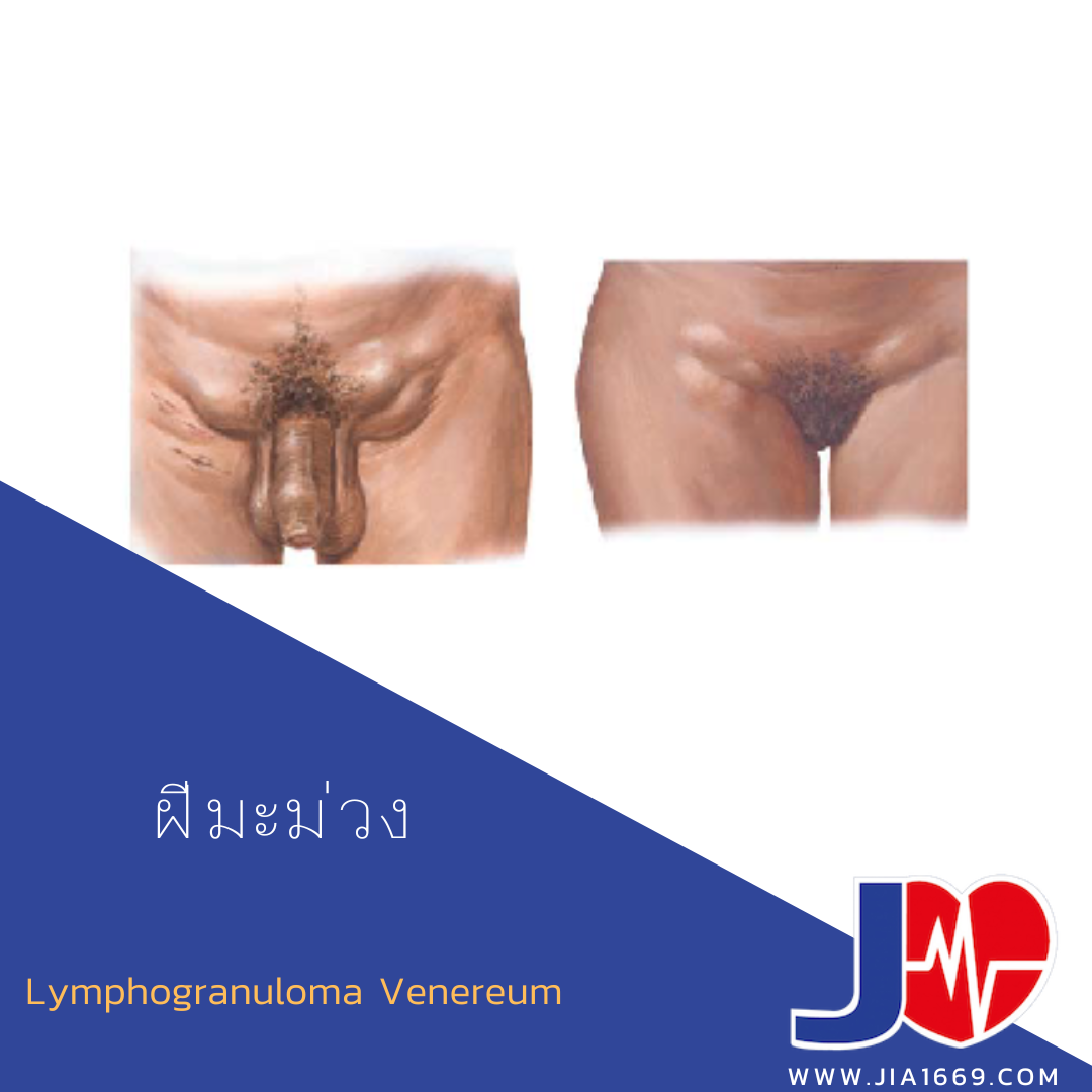  Lymphogranuloma Venereum