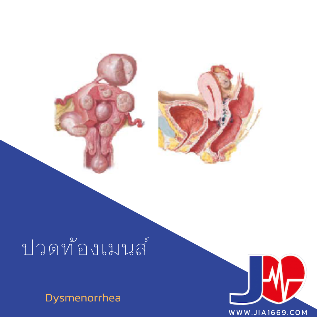 ปวดท้องเมนส์ ปวดท้องเมนส์