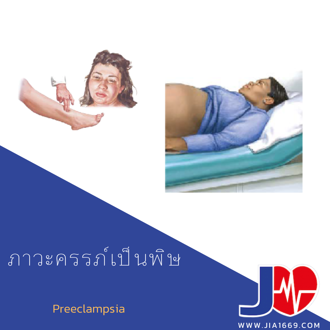 ภาวะครรภ์เป็นพิษ ภาวะครรภ์เป็นพิษ