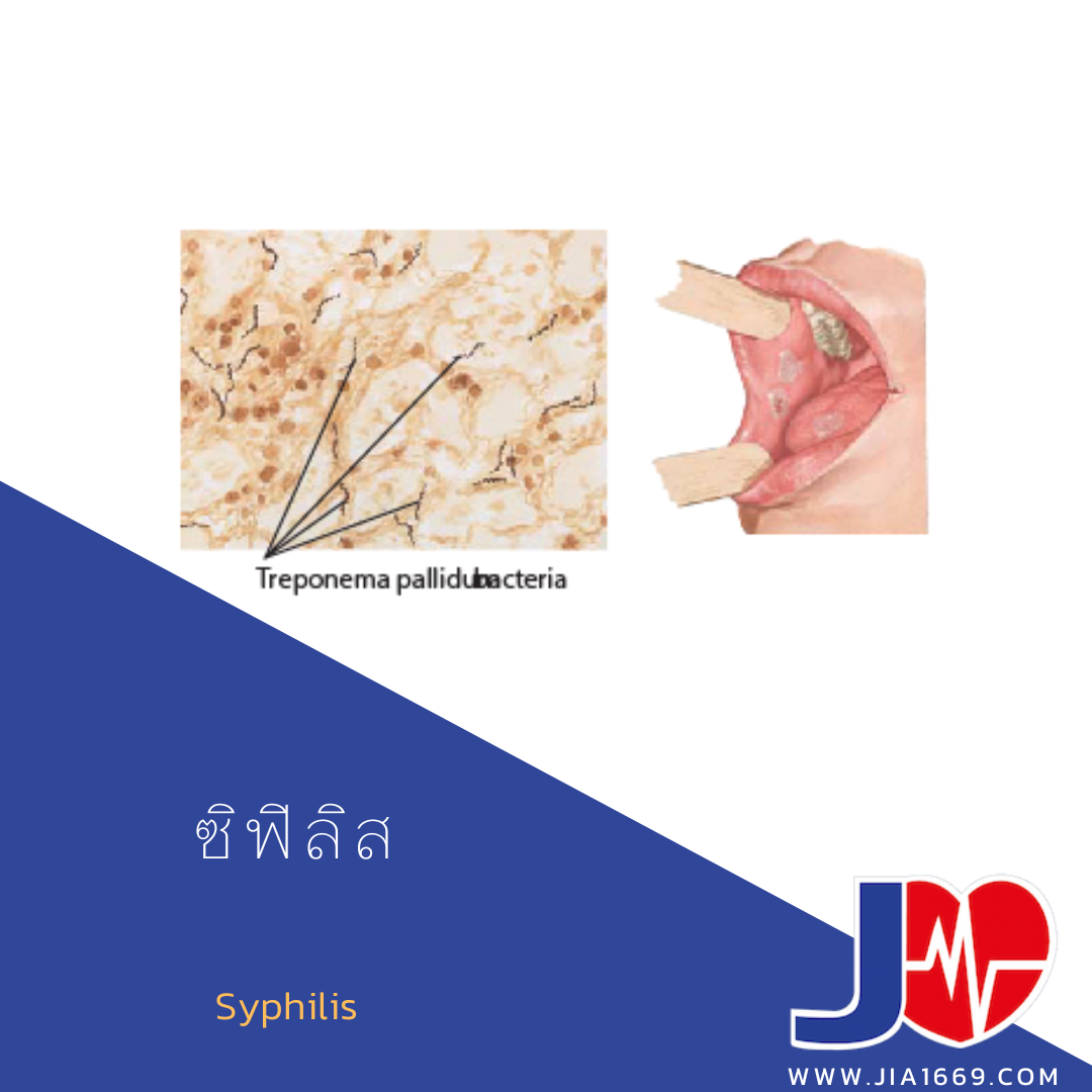 ซิฟิลิส ซิฟิลิส