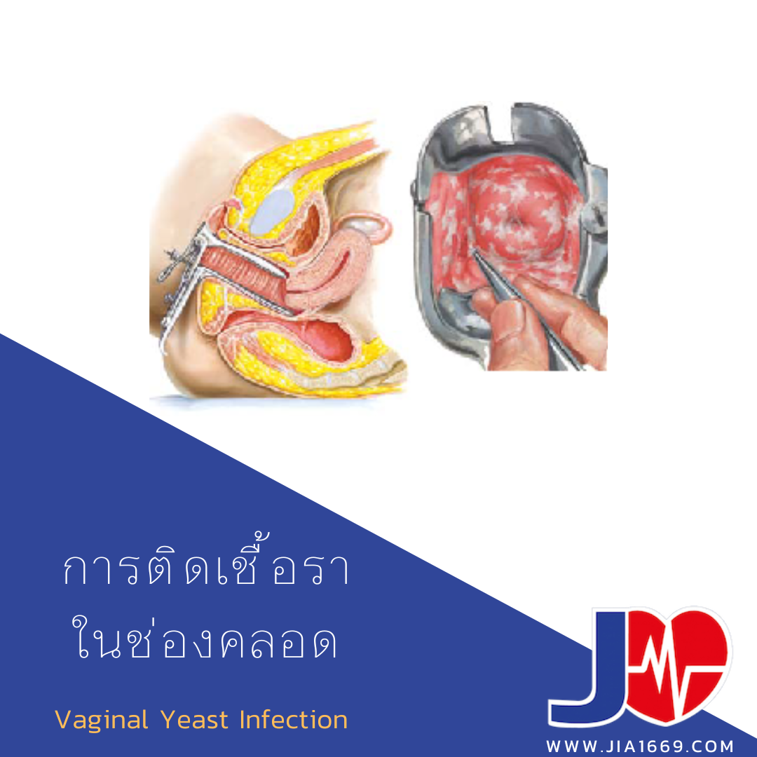 การติดเชื้อราในช่องคลอด การติดเชื้อราในช่องคลอด