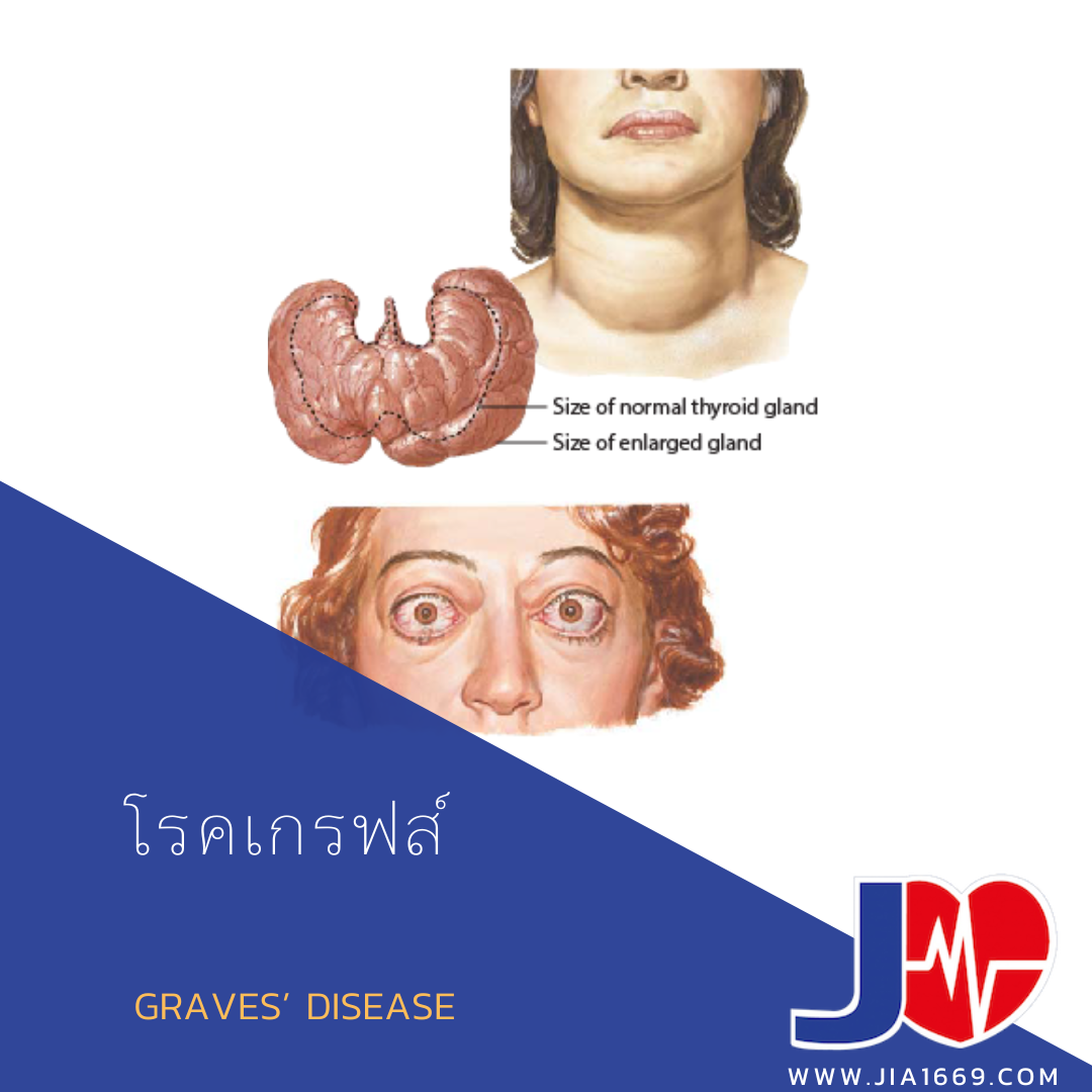 โรคเกรฟส์ โรคเกรฟส์
