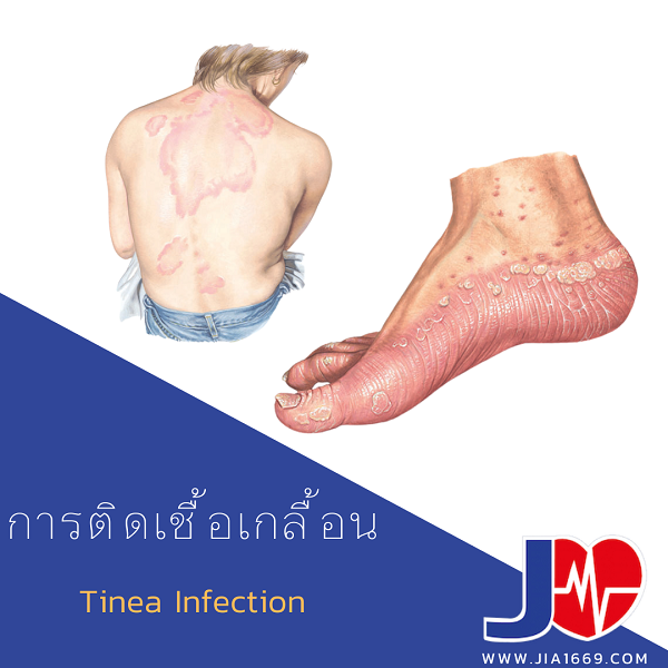 โรคติดเชื้อเกลื้อน โรคติดเชื้อเกลื้อน