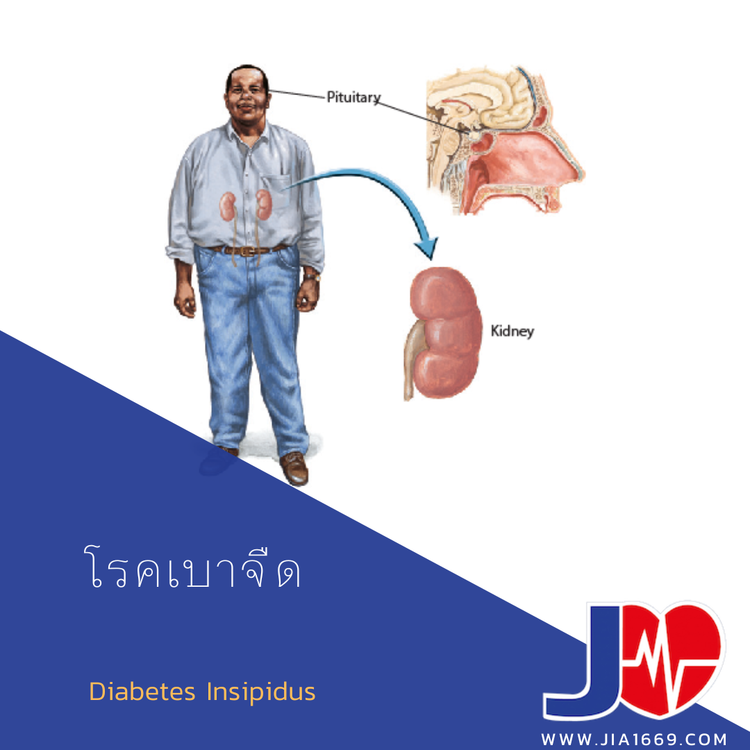 Diabetes Insipidus