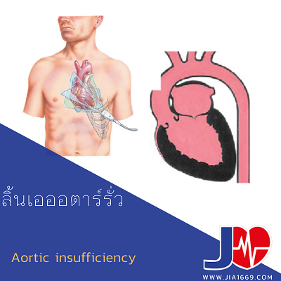 โรคลิ้นเอออตาร์รั่ว โรคลิ้นเอออตาร์รั่ว