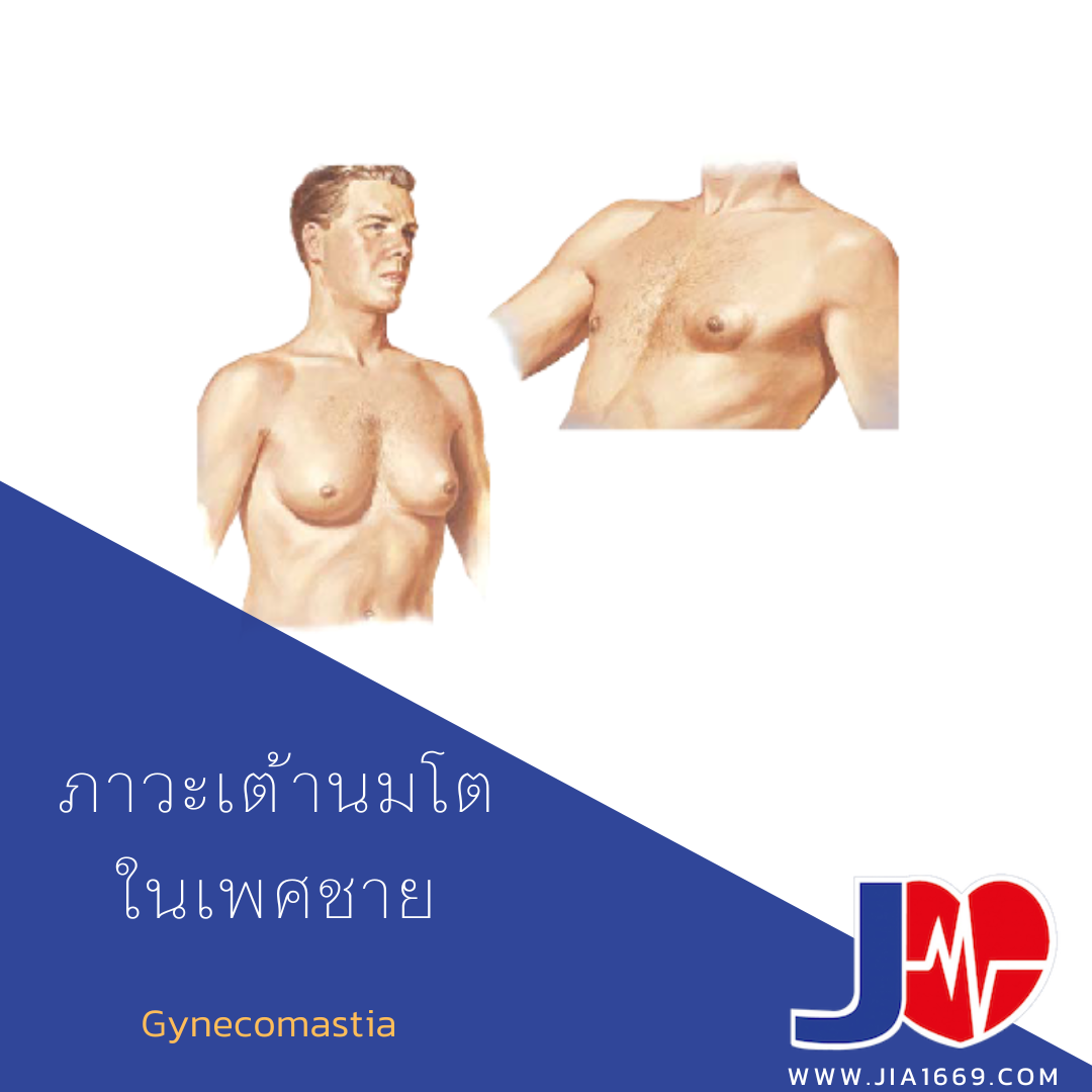 ภาวะเต้านมโตในเพศชาย ภาวะเต้านมโตในเพศชาย