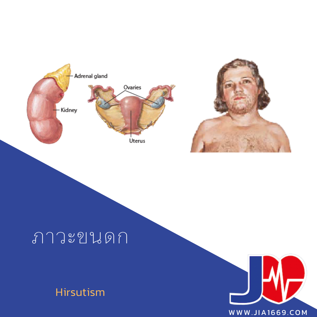 ภาวะขนดก ภาวะขนดก