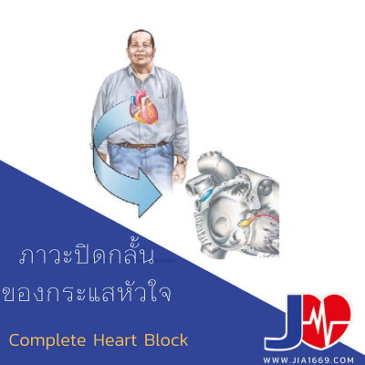 COMPLETE HEART BLOCK