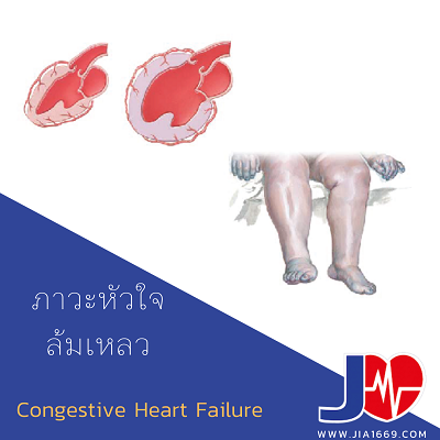CONGESTIVE HEART FAILURE (CHF) CONGESTIVE HEART FAILURE (CHF)