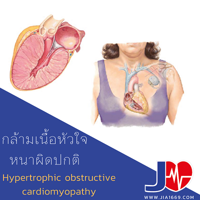 โรคกล้ามเนื้อหัวใจหนาผิดปกติ โรคกล้ามเนื้อหัวใจหนาผิดปกติ