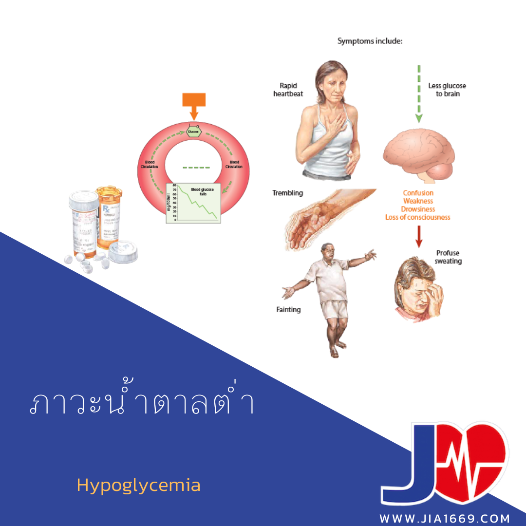 ภาวะน้ำตาลต่ำ ภาวะน้ำตาลต่ำ