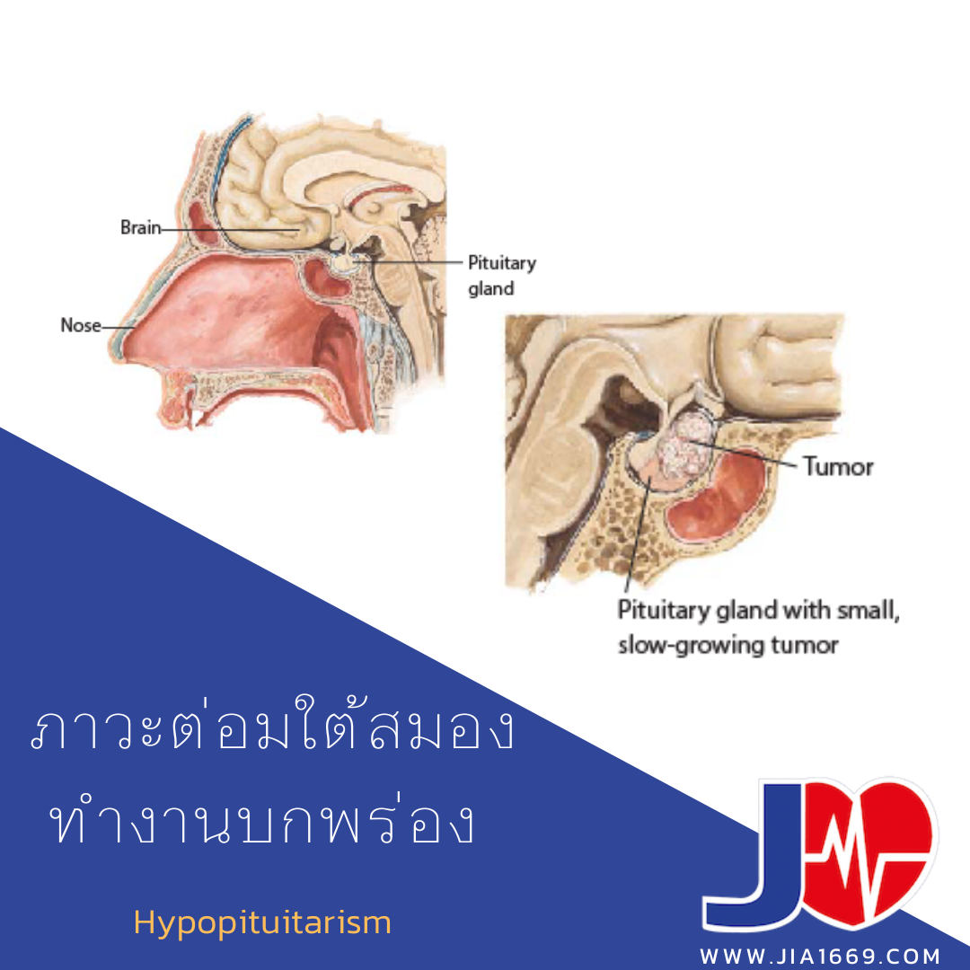 ภาวะต่อมใต้สมองทำงานบกพร่อง ภาวะต่อมใต้สมองทำงานบกพร่อง
