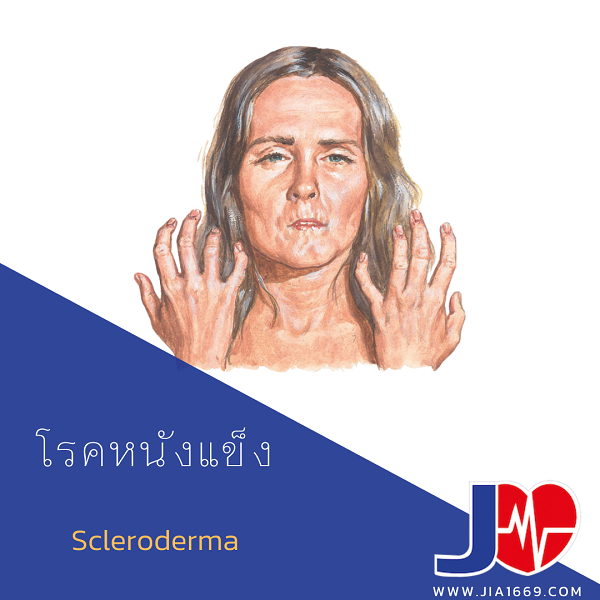 Scleroderma