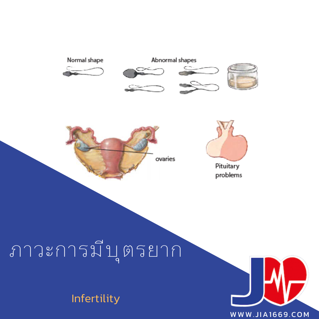 ภาวะการมีบุตรยาก ภาวะการมีบุตรยาก