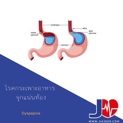 โรคกระเพาะอาหาร จุกแน่นท้อง (Dyspepsia)