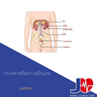 กระเพาะปัสสาวะอักเสบ กระเพาะปัสสาวะอักเสบ