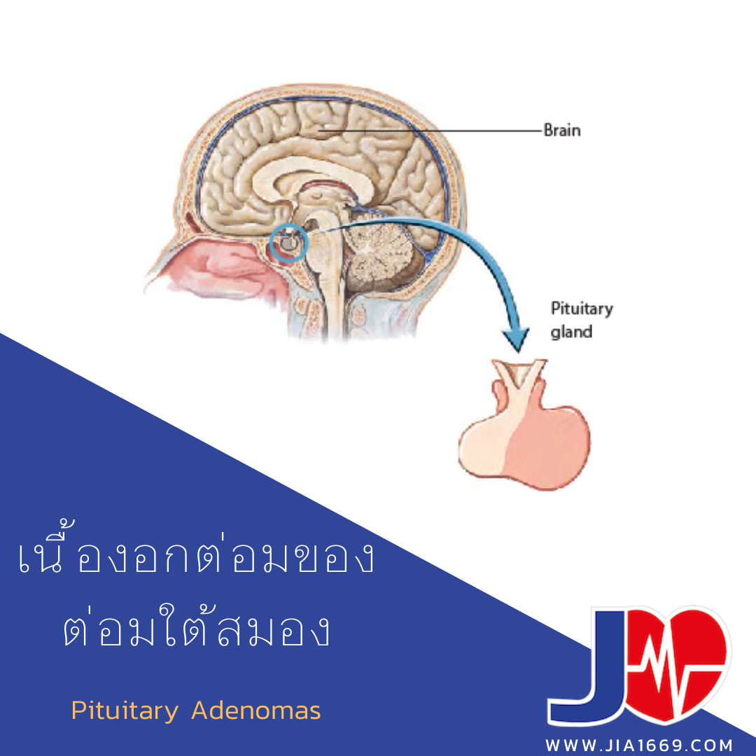 Pituitary Adenomas  Pituitary Adenomas