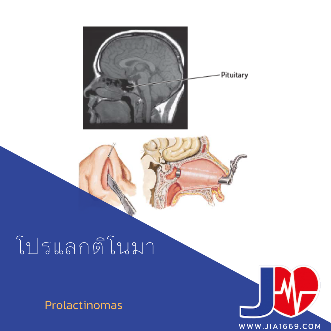 โปรแลกติโนมา โปรแลกติโนมา