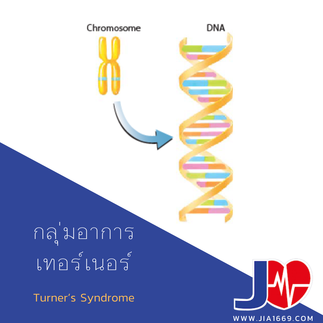 กลุ่มอาการเทอร์เนอร์ กลุ่มอาการเทอร์เนอร์