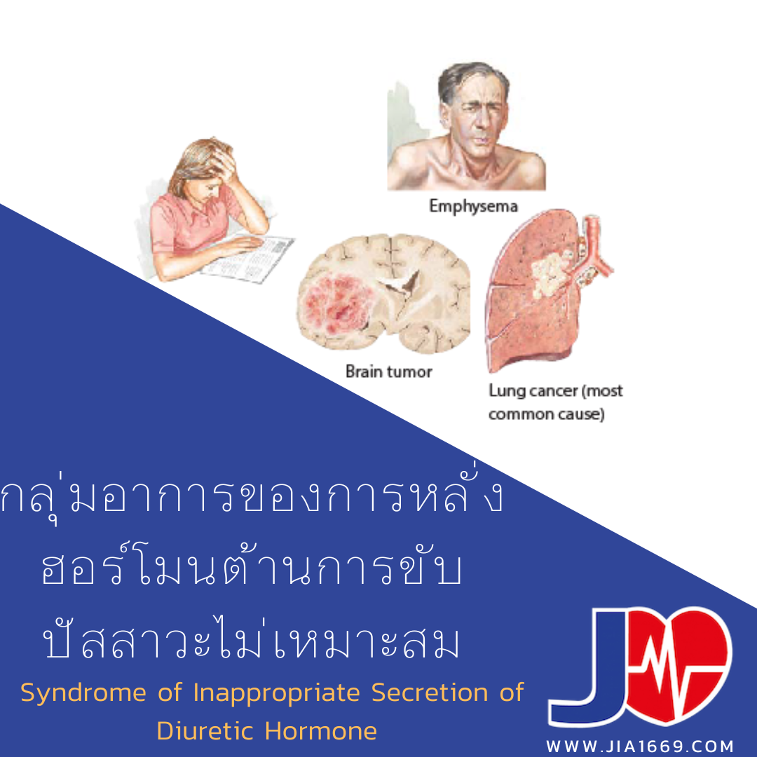 กลุ่มอาการของการหลั่งฮอร์โมนต้านการขับปัสสาวะไม่เหมาะสม กลุ่มอาการของการหลั่งฮอร์โมนต้านการขับปัสสาวะไม่เหมาะสม