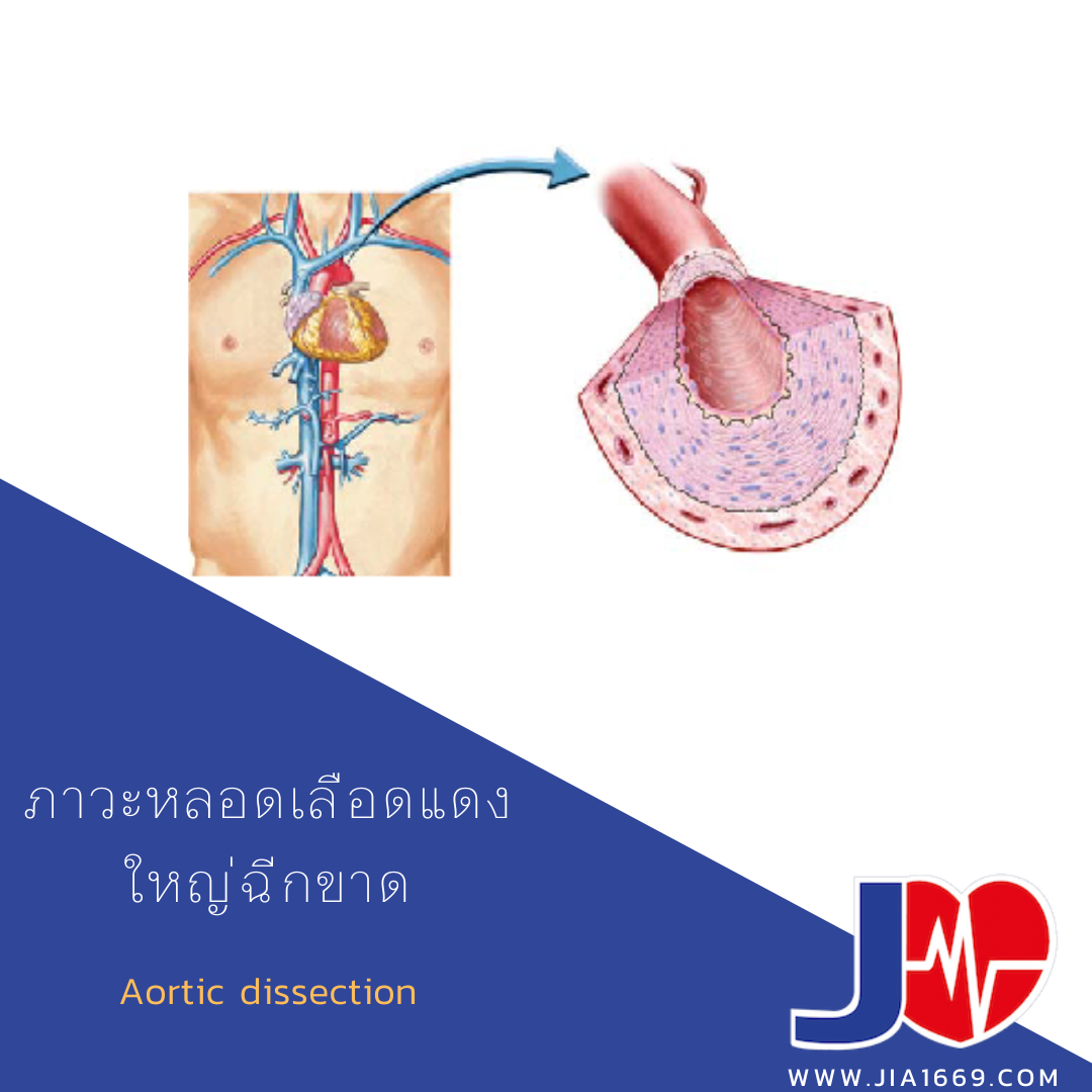 Aortic dissection 
