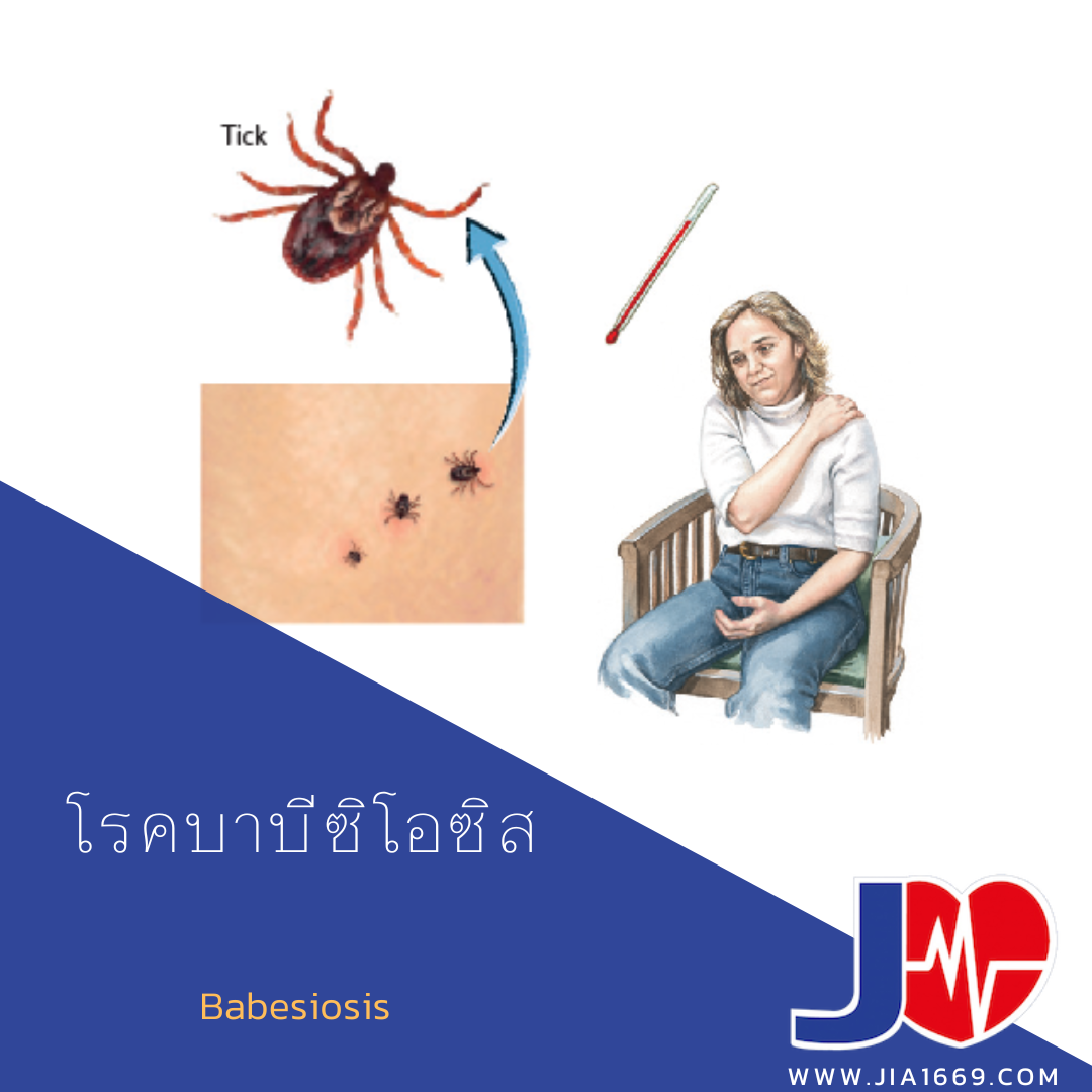 โรคบาบีซิโอซิส โรคบาบีซิโอซิส