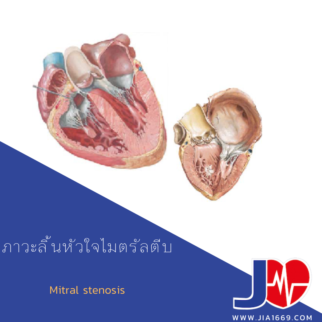ภาวะลิ้นหัวใจไมตรัลตีบ  ภาวะลิ้นหัวใจไมตรัลตีบ