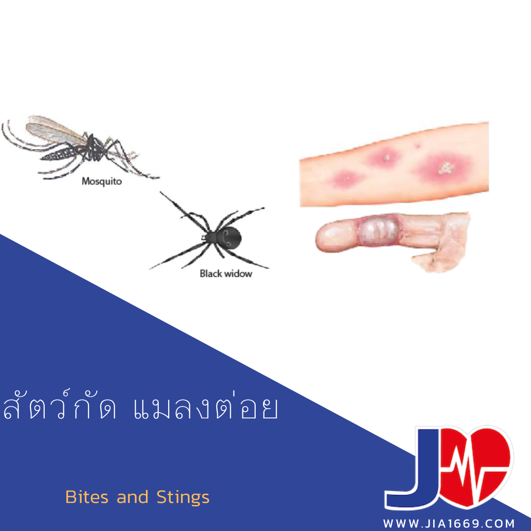 สัตว์กัด แมลงต่อย สัตว์กัด แมลงต่อย