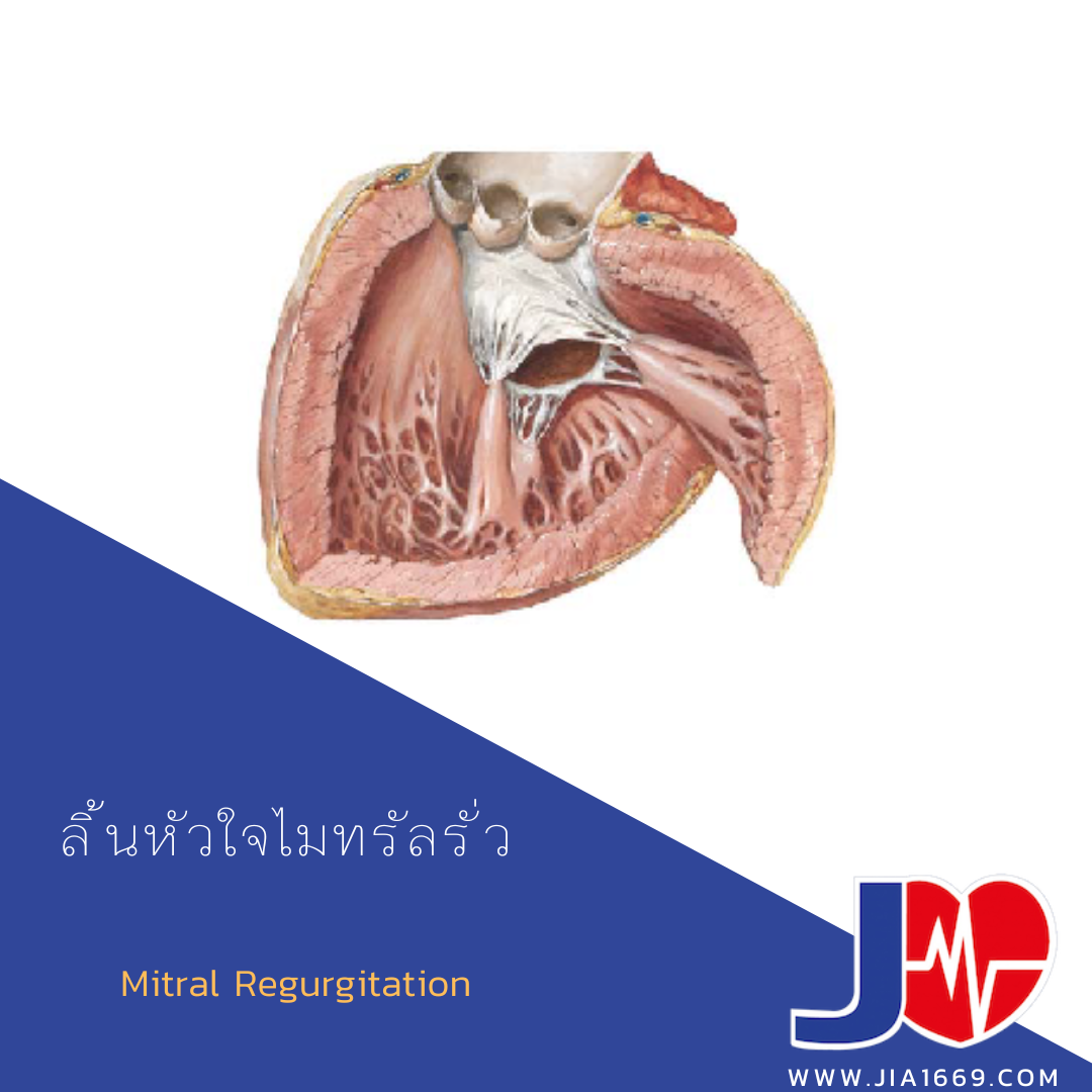ลิ้นหัวใจไมทรัลรั่ว ลิ้นหัวใจไมทรัลรั่ว