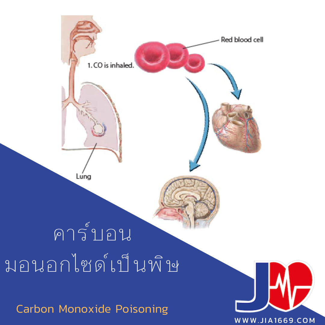 Carbon Monoxide Poisoning  Carbon Monoxide Poisoning