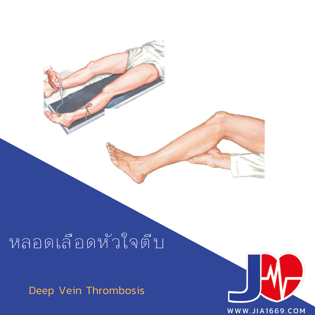 หลอดเลือดหัวใจตีบ หลอดเลือดหัวใจตีบ