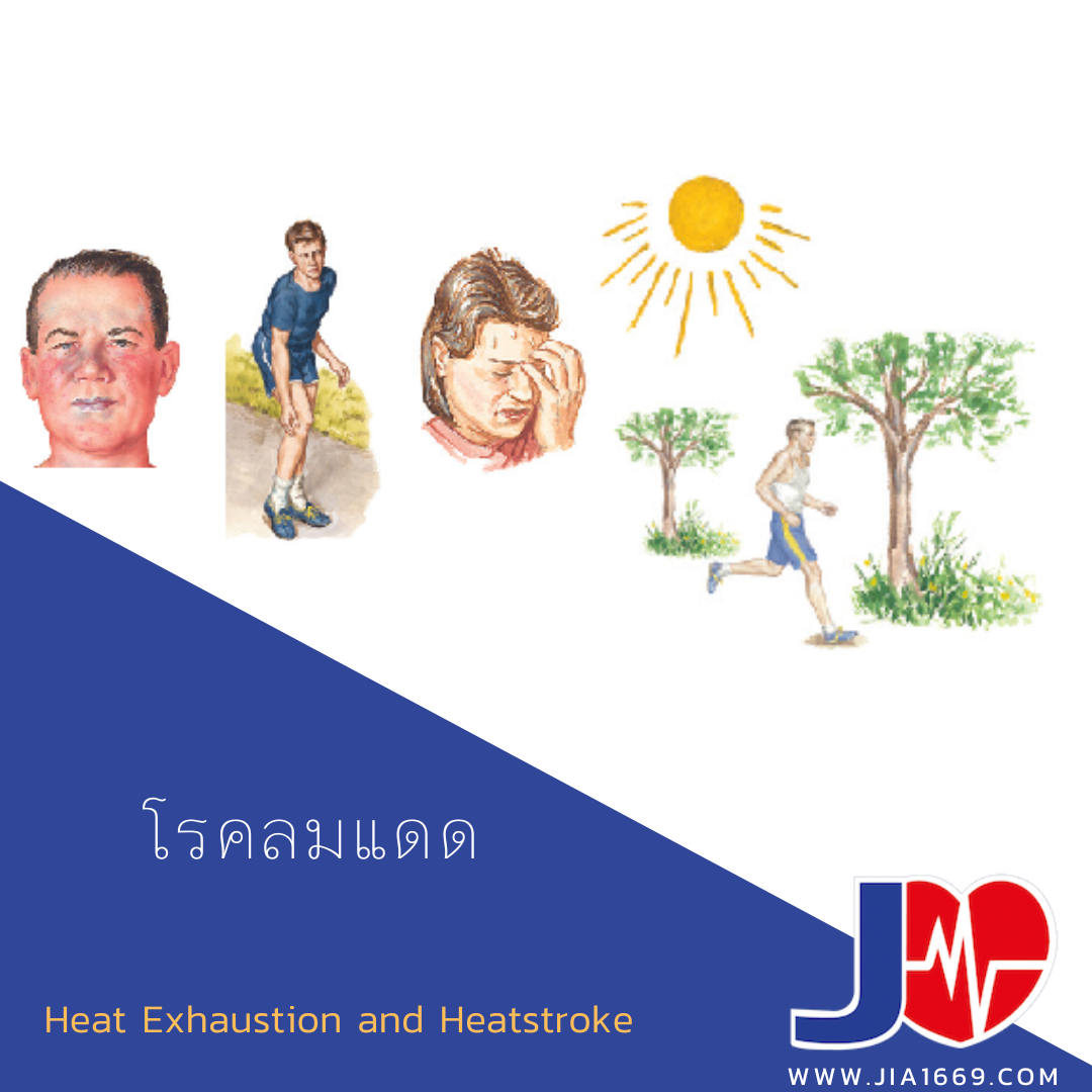 โรคลมแดด โรคลมแดด