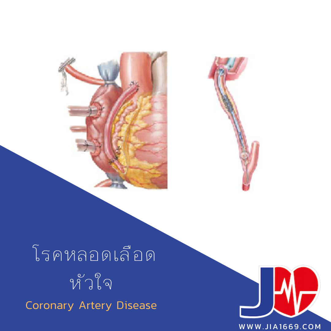 โรคหลอดเลือดหัวใจ โรคหลอดเลือดหัวใจ
