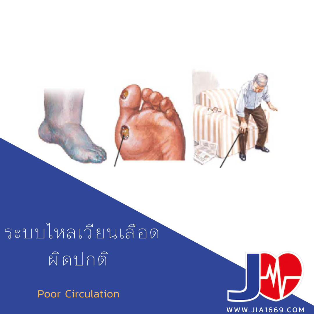 ระบบไหลเวียนเลือดผิดปกติ ระบบไหลเวียนเลือดผิดปกติ