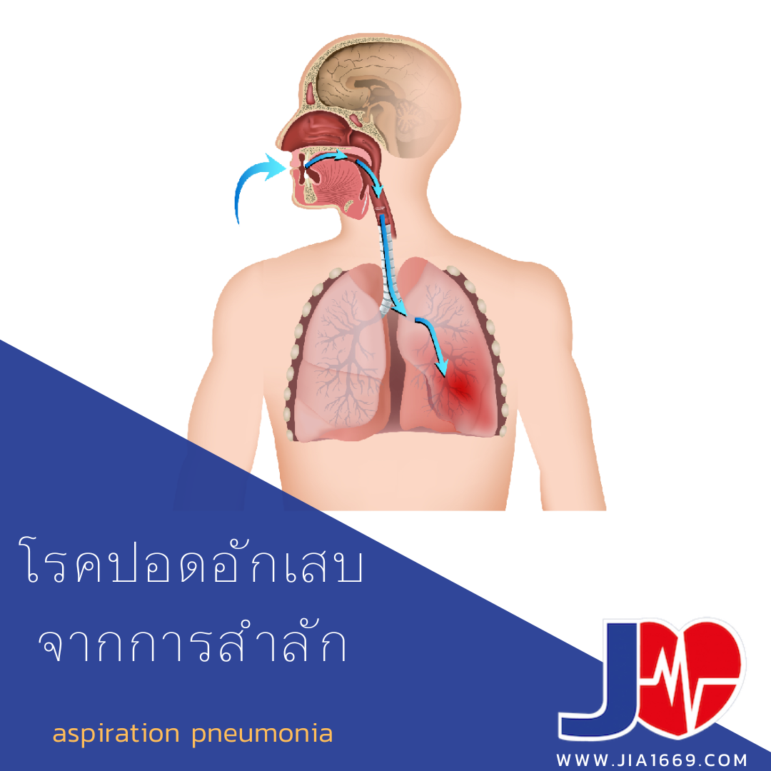 aspiration pneumonia