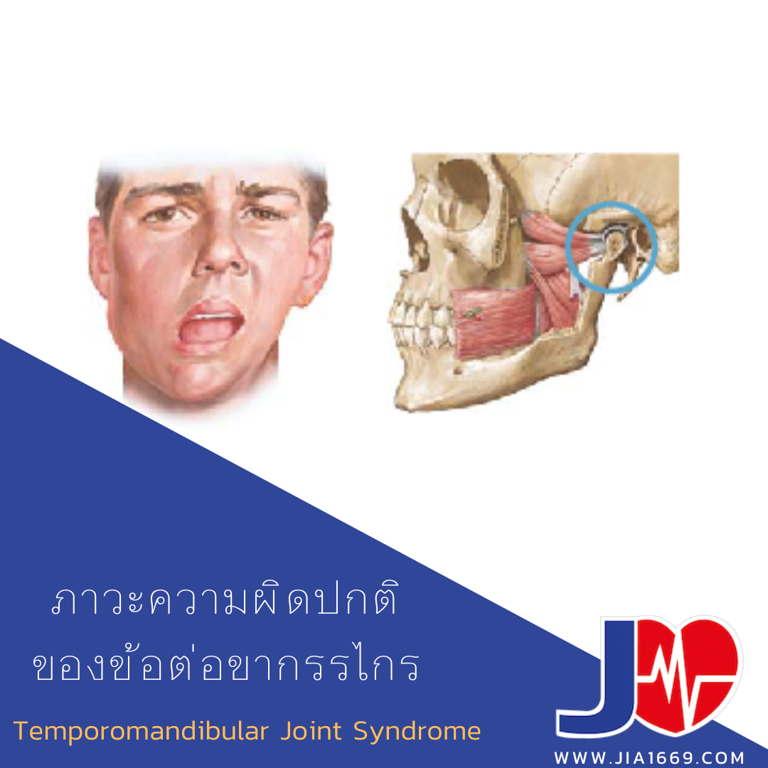 ภาวะความผิดปกติของข้อต่อขากรรไกร ภาวะความผิดปกติของข้อต่อขากรรไกร