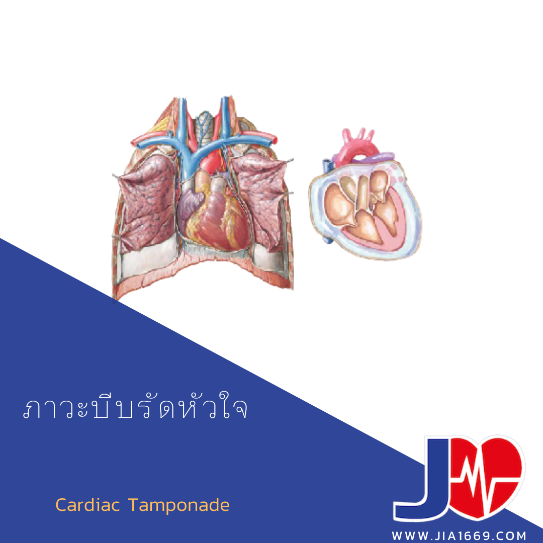 ภาวะบีบรัดหัวใจ ภาวะบีบรัดหัวใจ