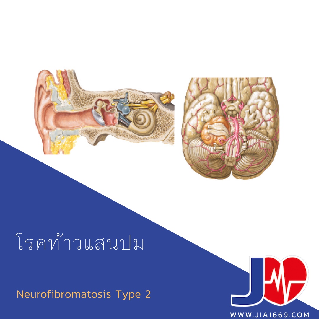 โรคท้าวแสนปม  โรคท้าวแสนปม