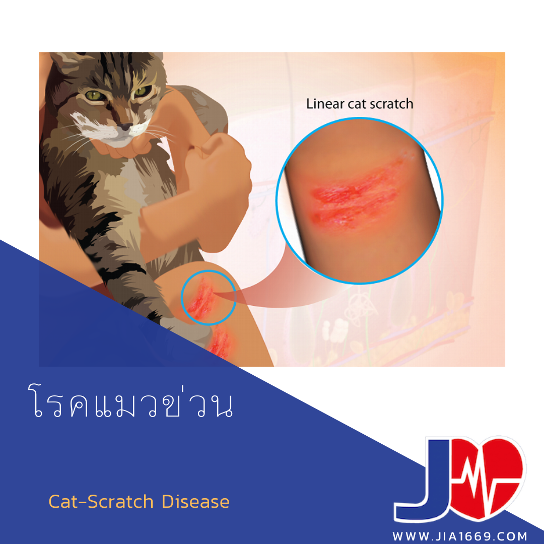 Cat-Scratch Disease  Cat-Scratch Disease