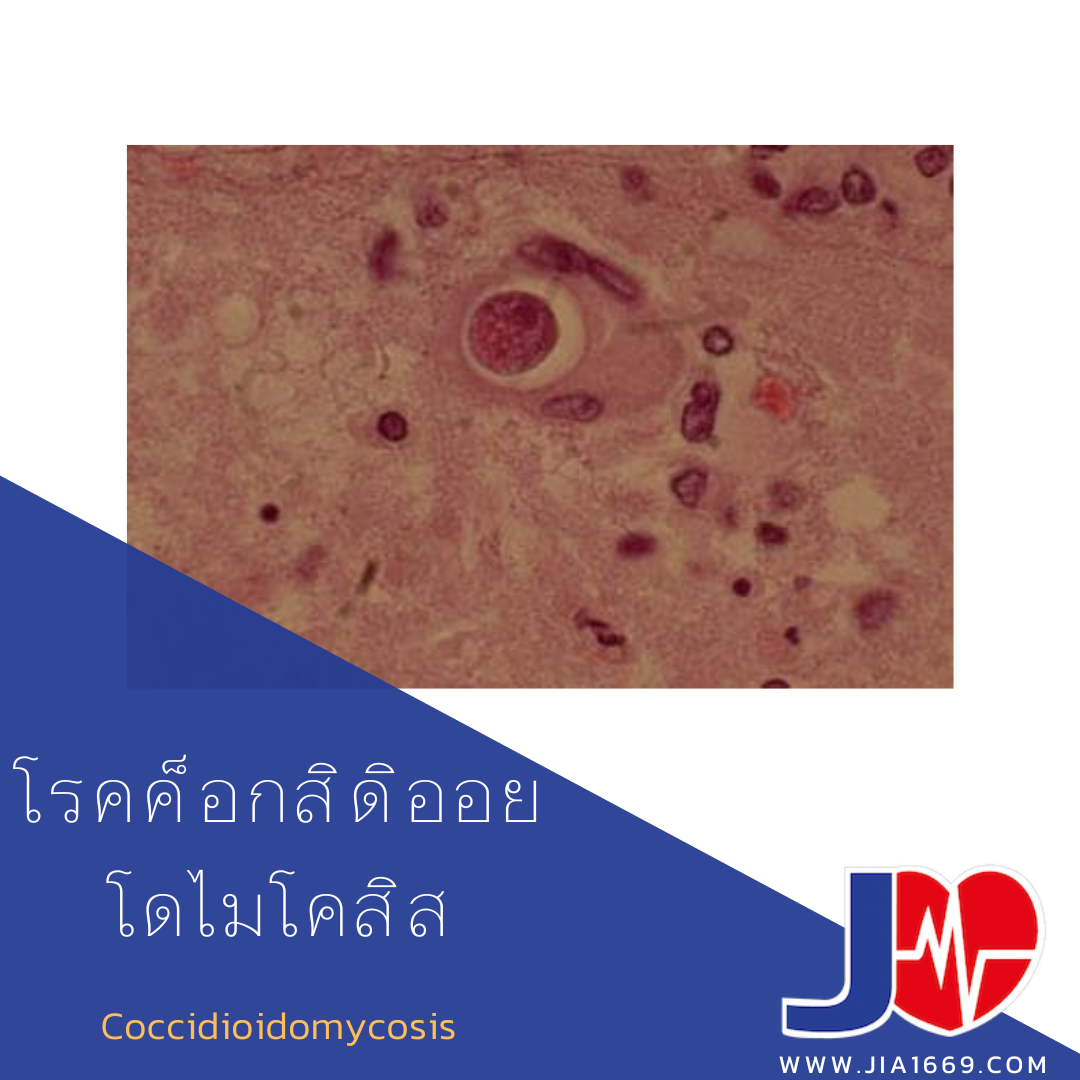 Coccidioidomycosis 