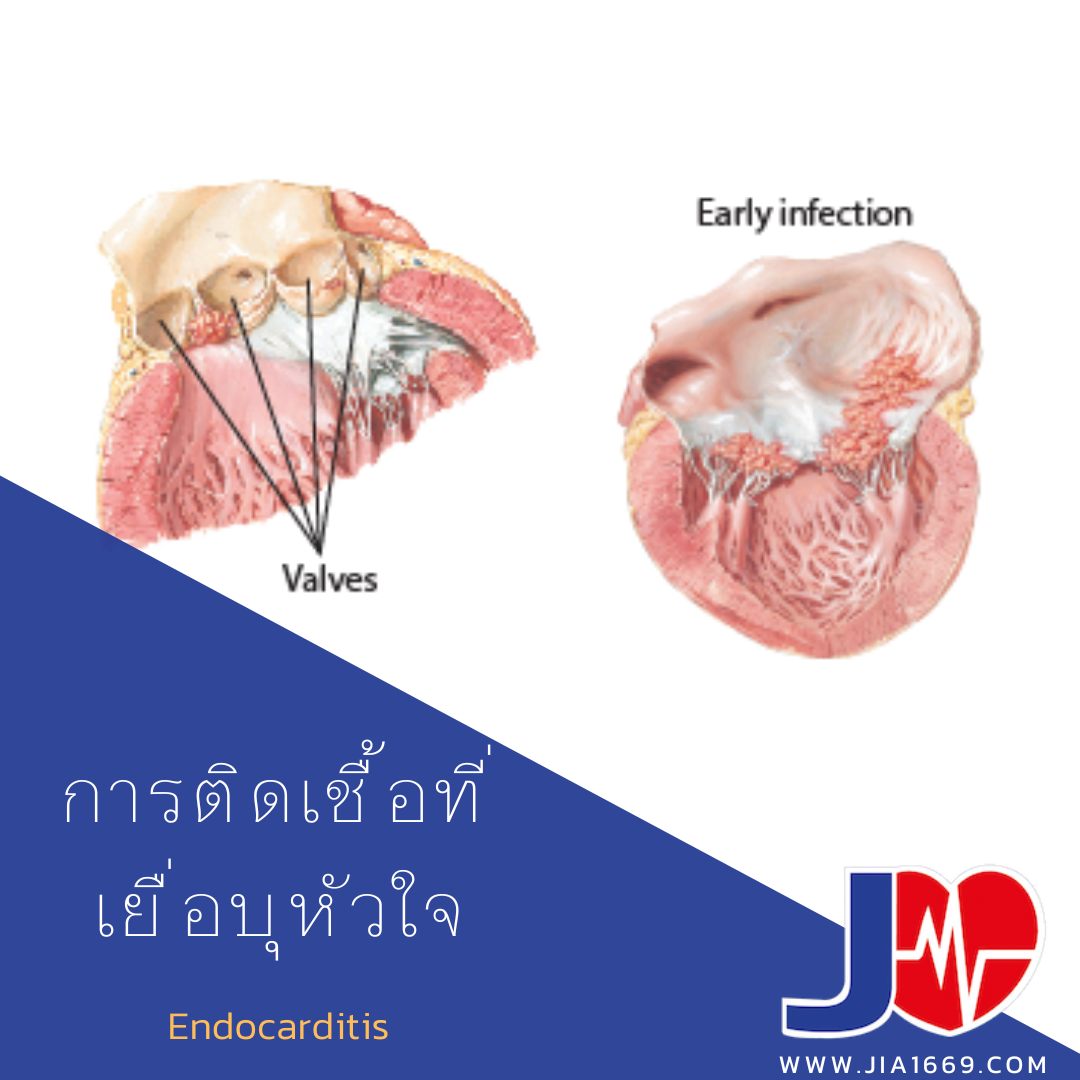 การติดเชื้อที่เยื่อบุหัวใจ การติดเชื้อที่เยื่อบุหัวใจ
