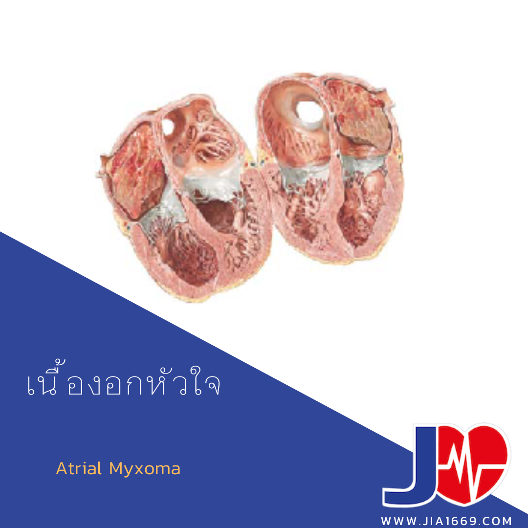 เนื้องอกหัวใจ เนื้องอกหัวใจ