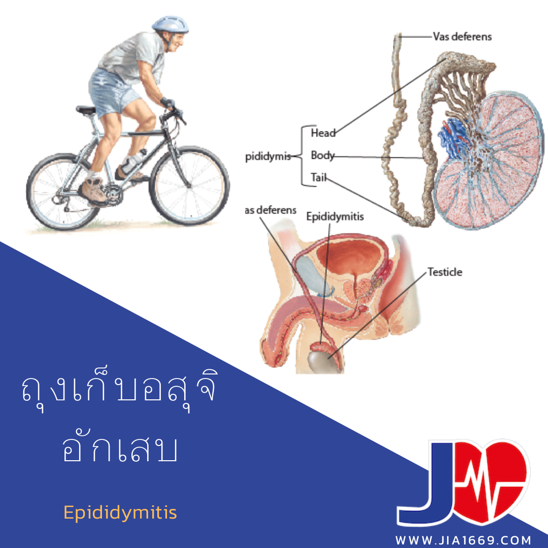 ถุงเก็บอสุจิอักเสบ ถุงเก็บอสุจิอักเสบ