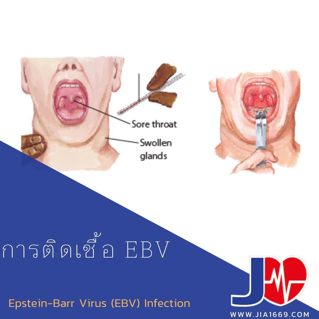 การติดเชื้อ EBV การติดเชื้อ EBV
