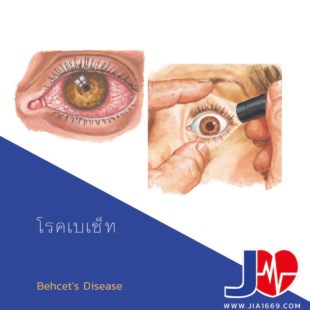 โรคเบเช็ท  โรคเบเช็ท