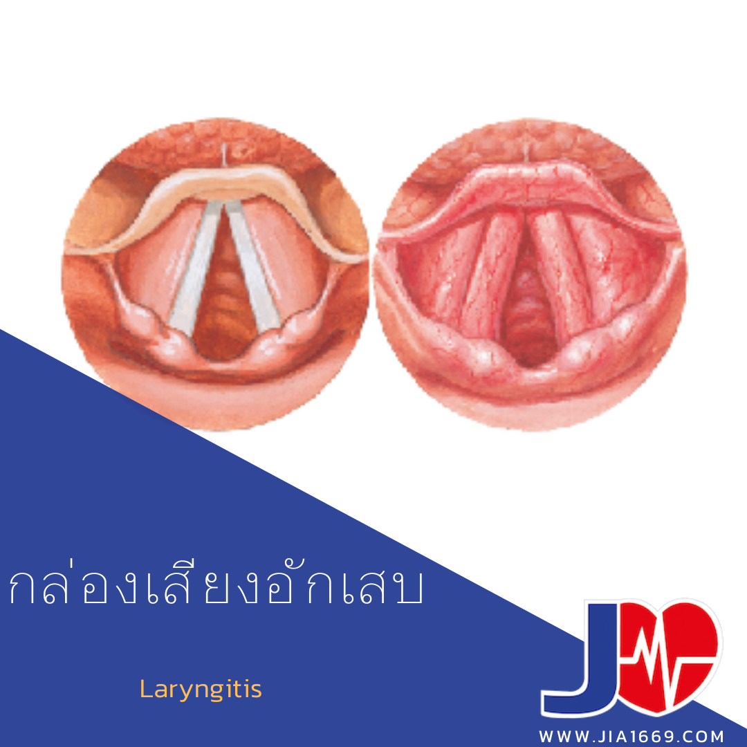 กล่องเสียงอักเสบ กล่องเสียงอักเสบ